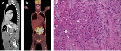 Case Report: Long-Term Survival of a Pediatric Patient With an Intra-Abdominal Undifferentiated Carcinoma of Unknown Primary